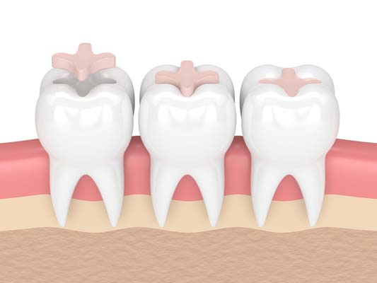 What Are Dental Sealants For Teeth?